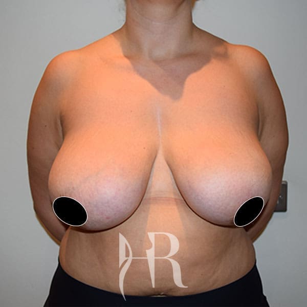 HR Plastic Surgery - Breast Reduction patient before 13